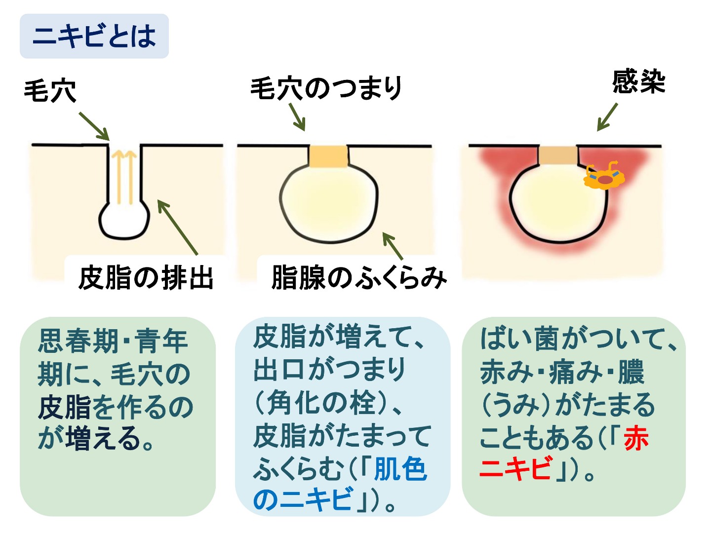 ニキビ ゲル ダラシン t