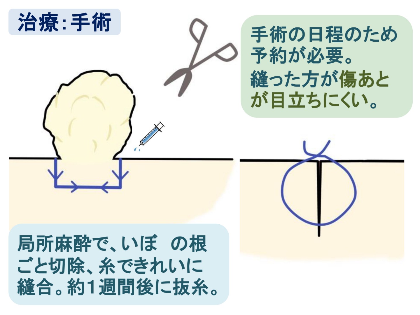 治療:手術